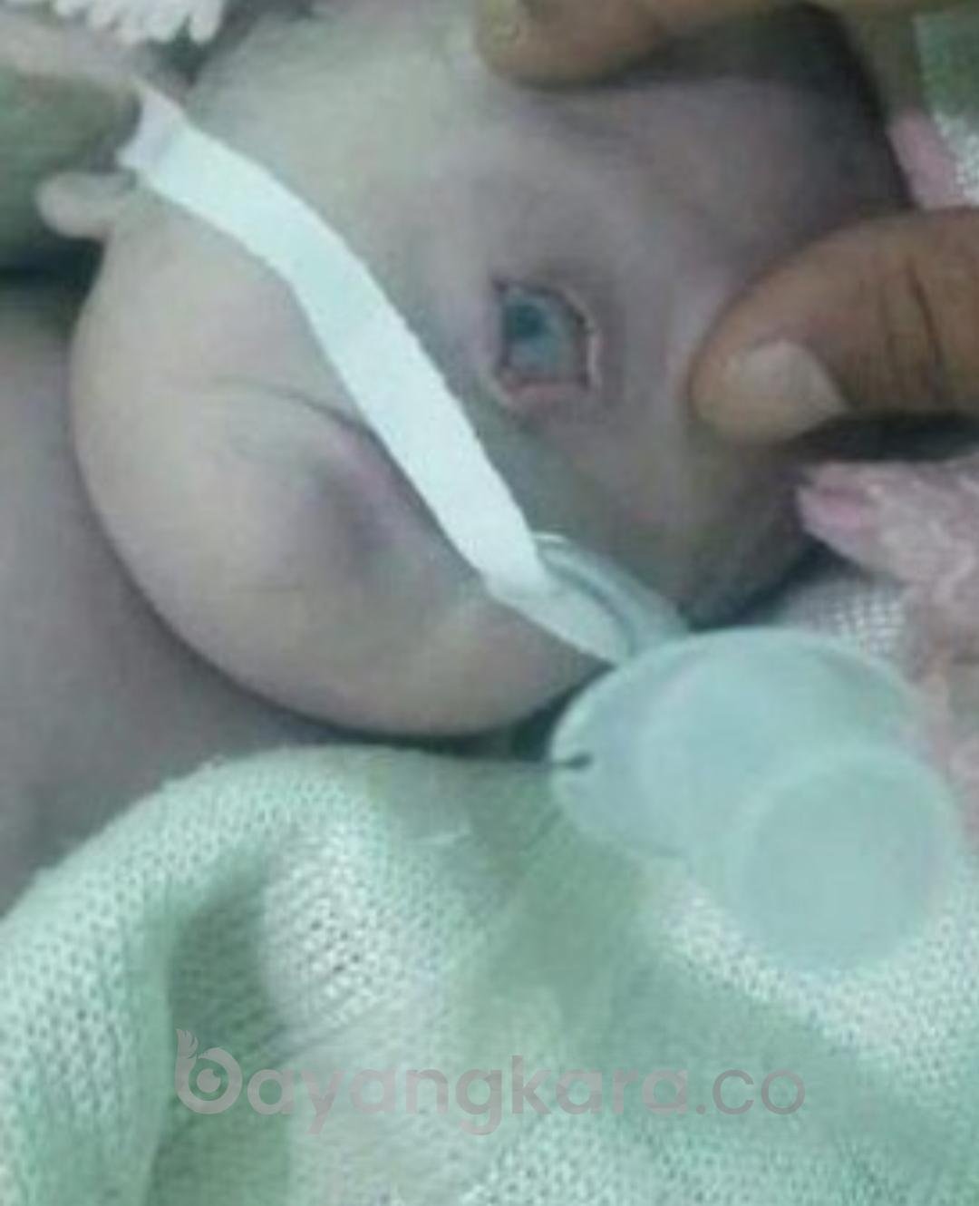 Viral Bayi Bermata Satu Lahir di Yaman