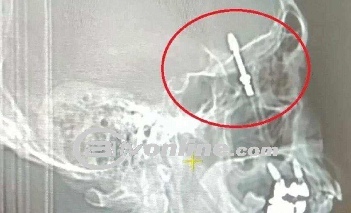 Insiden Mengerikan di Klinik Gigi! Pria Alami Bahaya Saat Pemasangan Implan!