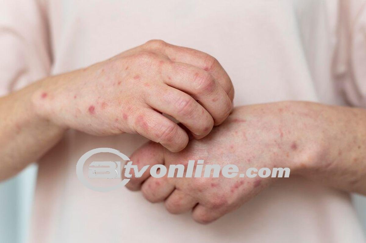 Breaking News! Dua Kasus Positif Monkeypox Terdeteksi di Tangerang Selatan