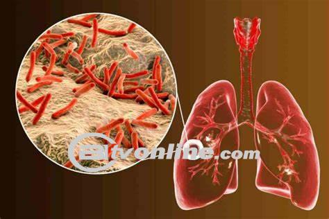 Tingginya Angka Kasus Tuberkulosis di Kota Medan: Dinas Kesehatan Siapkan Gerakan Cepat Tangkap