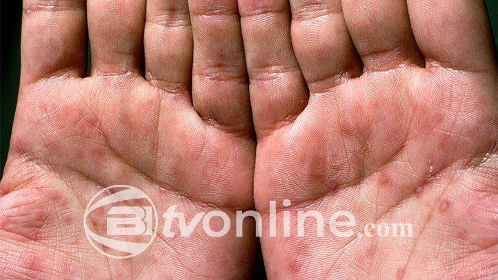 14 Remaja di Medan Terinfeksi Sifilis Sepanjang 2024, Didominasi Hubungan Seks Sesama Jenis