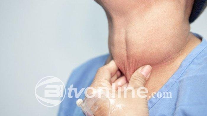 Makanan Yang Dianjurkan untuk Pengidap Tiroid,  Hipotiroid dan Hipertiroid
