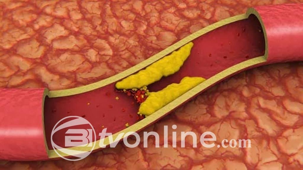 Meningkatnya Penyakit Kronis pada Anak Akibat Pola Konsumsi Jajanan yang Tidak Sehat