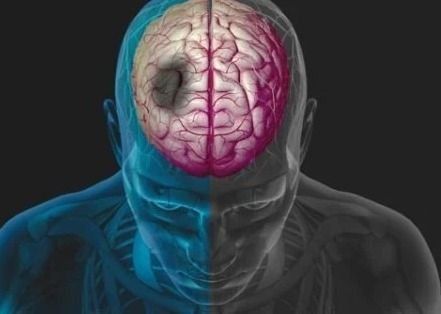6 Kebiasaan Sehat untuk Mencegah Risiko Stroke