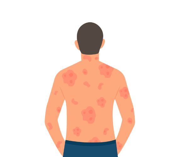 Psoriasis: Saat Sistem Imun Menyerang Kulit Sendiri, Bukan Penyakit Menular!
