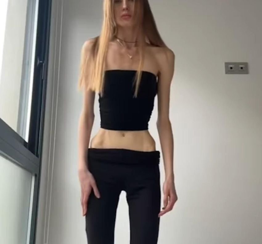 Tren Diet 'SkinnyTok' di TikTok Dapat Picu Gangguan Makan dan Bahaya Kesehatan