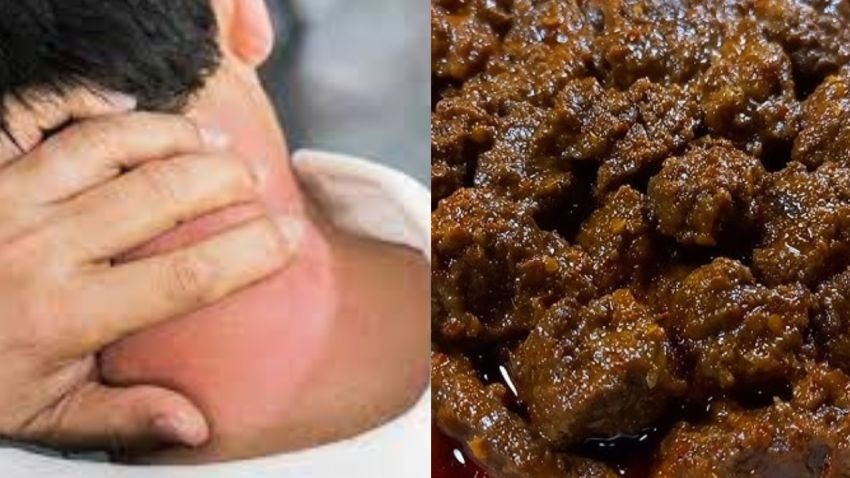 Waktu Terbaik Minum Obat Kolesterol Setelah Pesta Daging Kurban, Ini Penjelasan Dokter