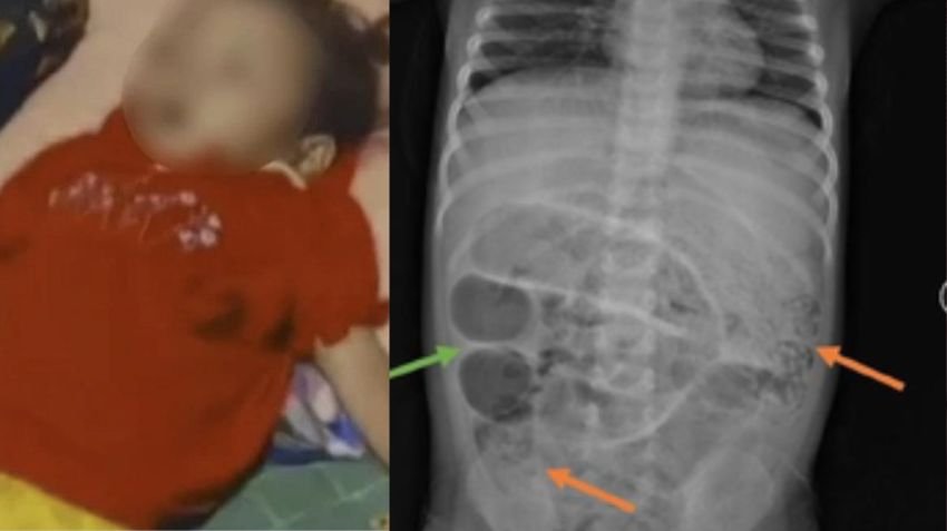 DPR Soroti Kasus Bocah Meninggal karena Infeksi Cacing di Sukabumi, Zainul Munasichin: Ini Tamparan Keras!