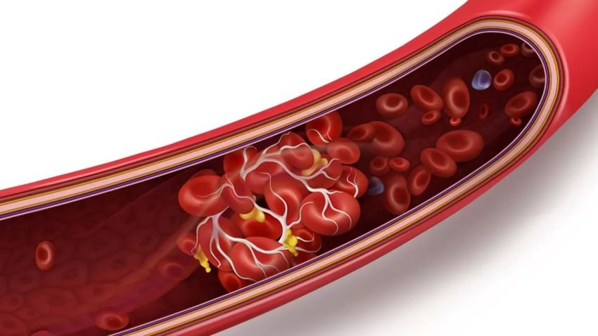 Waspada! 7 Gejala Pembekuan Darah yang Sering Diabaikan, Bisa Picu Stroke hingga Serangan Jantung