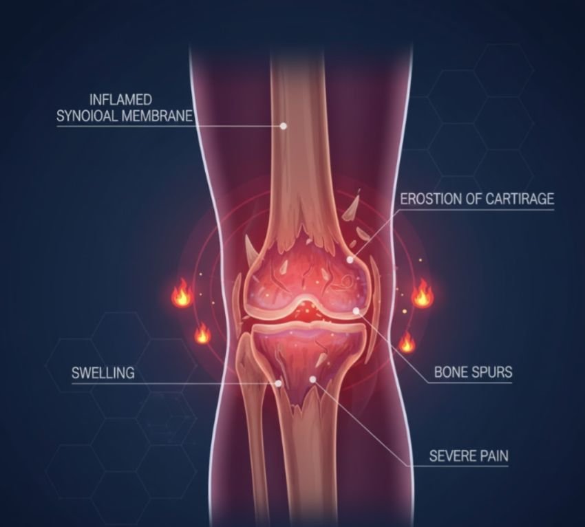 41,7 Persen Masyarakat Indonesia Alami Osteopenia, Waspadai Risiko Patah Tulang