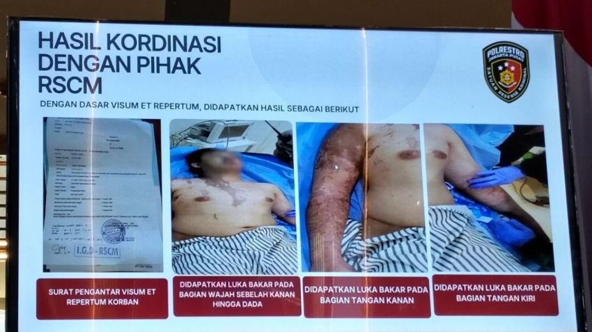 Kondisi Andrie Yunus Berangsur Pulih Usai Disiram Air Keras, Alami Luka Bakar 20 Persen dan Kerusakan Kornea Mata